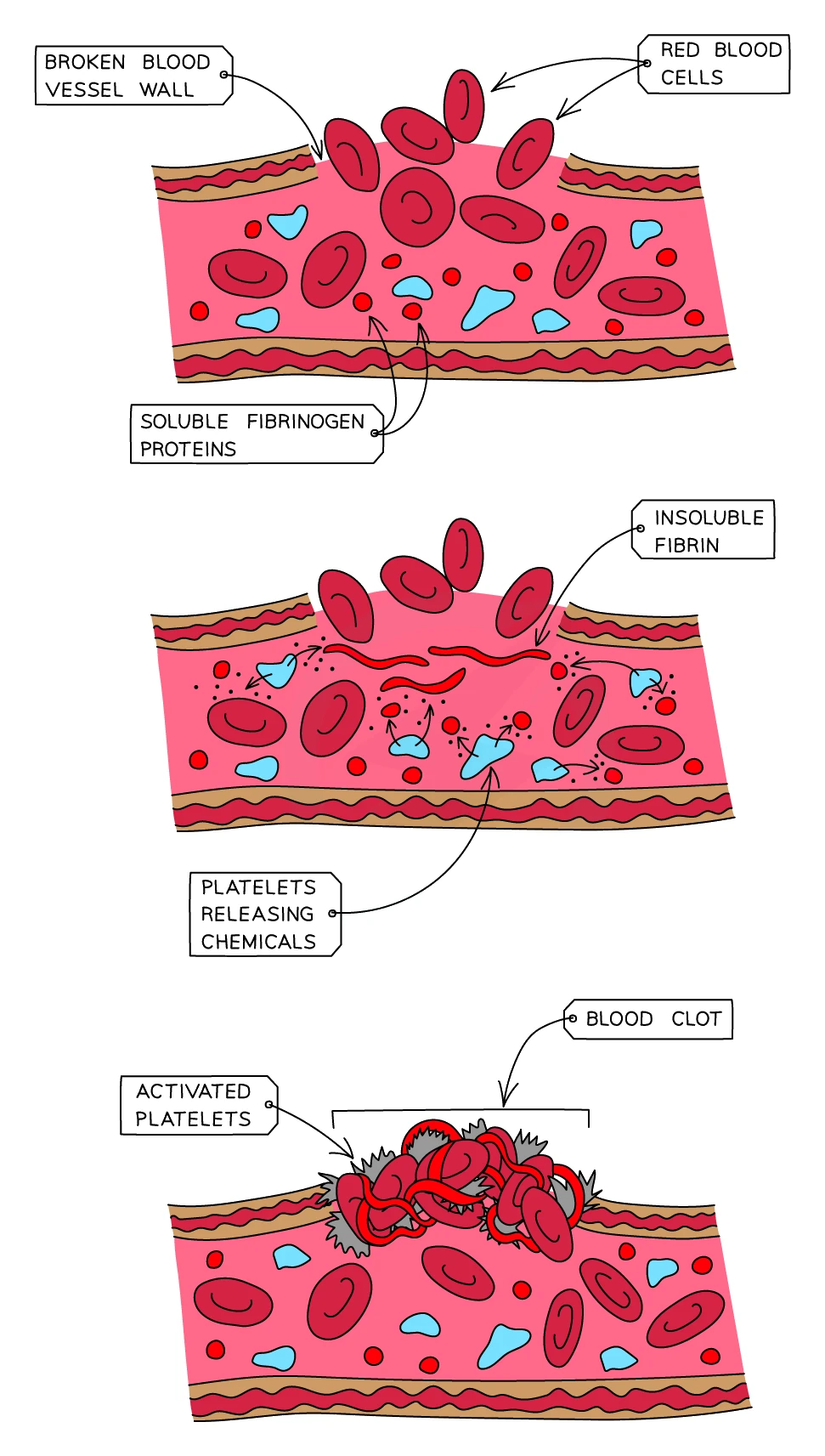 Blood clotting shown in three stages at a broken blood vessel wall: red blood cells and soluble fibrinogen proteins at the wound, then platelets releasing chemicals that convert fibrinogen into insoluble fibrin, then a mesh of fibrin trapping red blood cells and activated platelets to form a blood clot