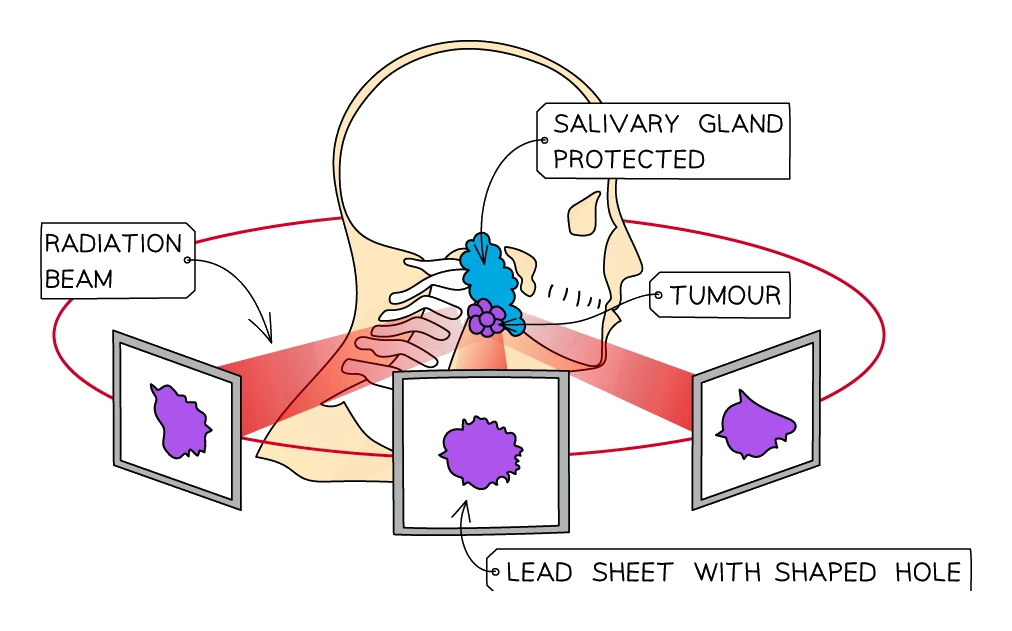 Radiotherapy: a gamma beam is directed at a tumour from several different directions as the source rotates around the patient, so the beams all cross at the tumour, which receives the full combined dose while healthy tissue on each path gets only a small dose
